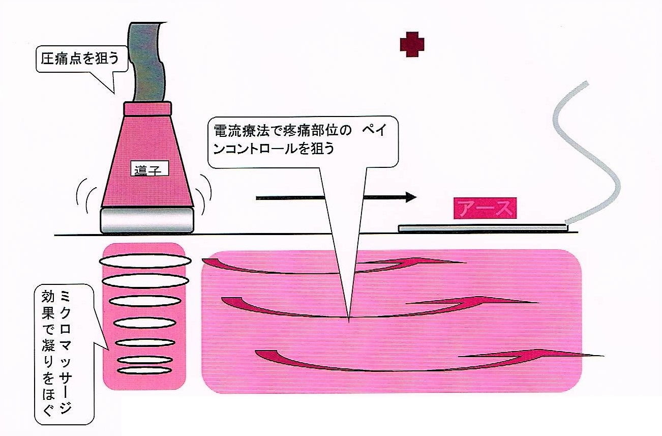 img src=”cyouon.jpeg” alt=”江井ヶ島でこの1台。超音波コンビネーション治療の説明”