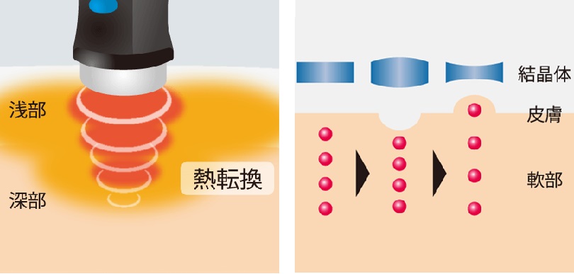 img src=”cyouon2.jpg” alt=”江井ヶ島でこの1台。超音波治療の効果をわかりやすく説明”